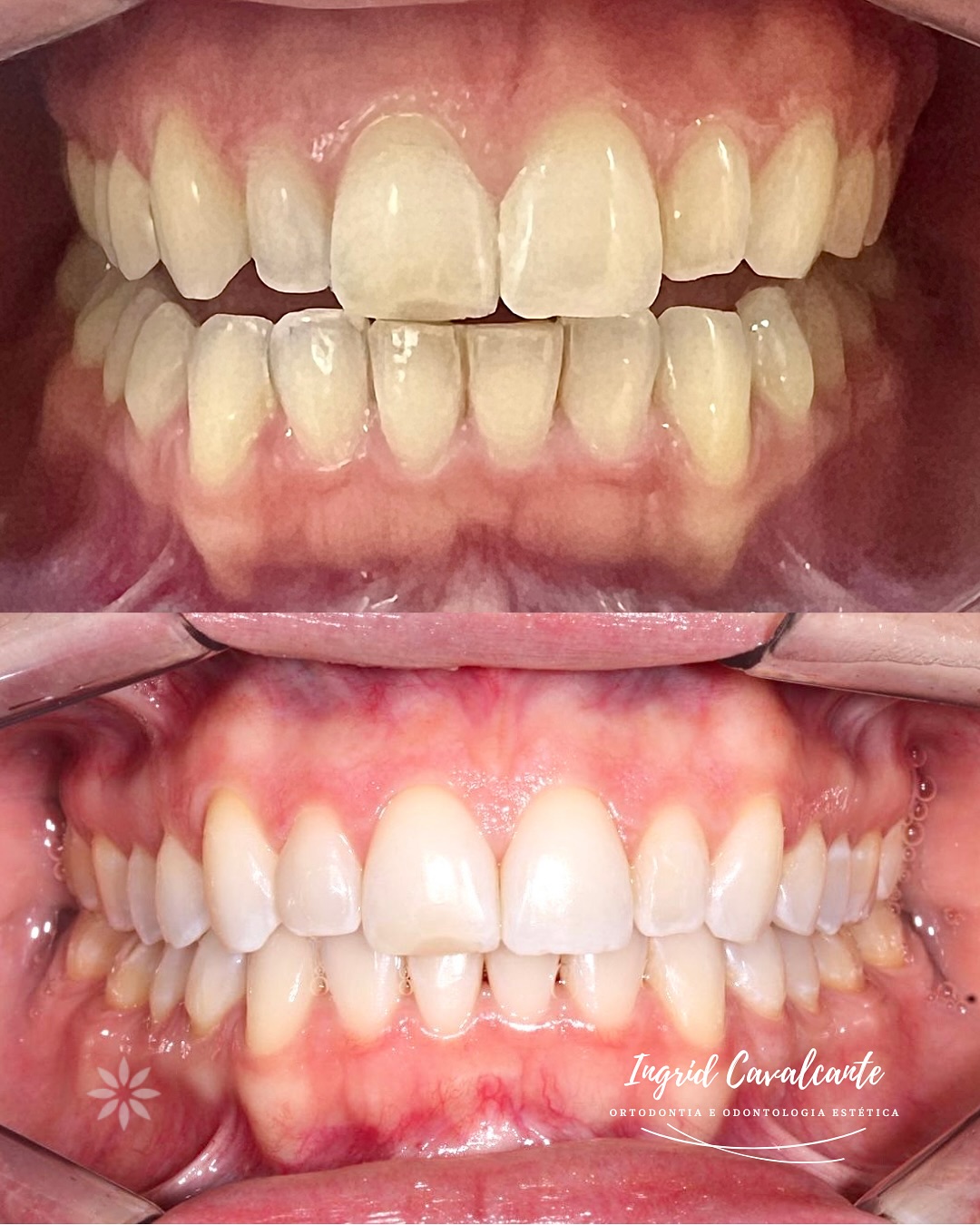 Resultado de tratamento odontológico — antes e depois