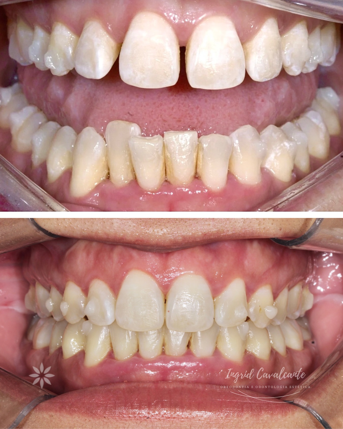 Resultado de tratamento odontológico — antes e depois