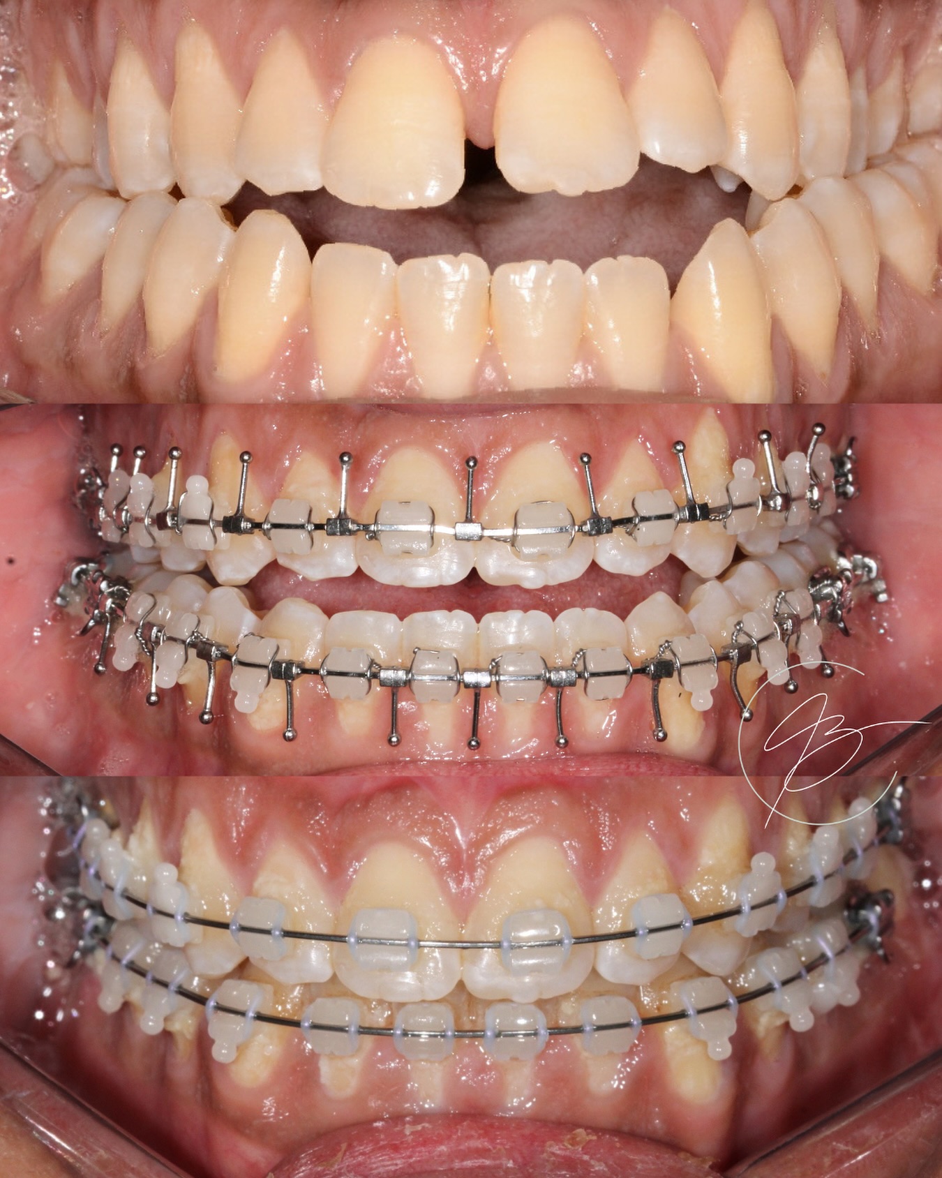 Resultado de tratamento odontológico — antes e depois